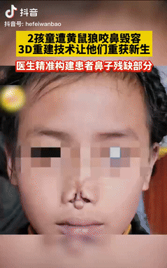 这才是真专家！四川甘孜，2藏族孩童小时候睡觉时，意外被黄鼠狼咬掉鼻子，导致她们一
