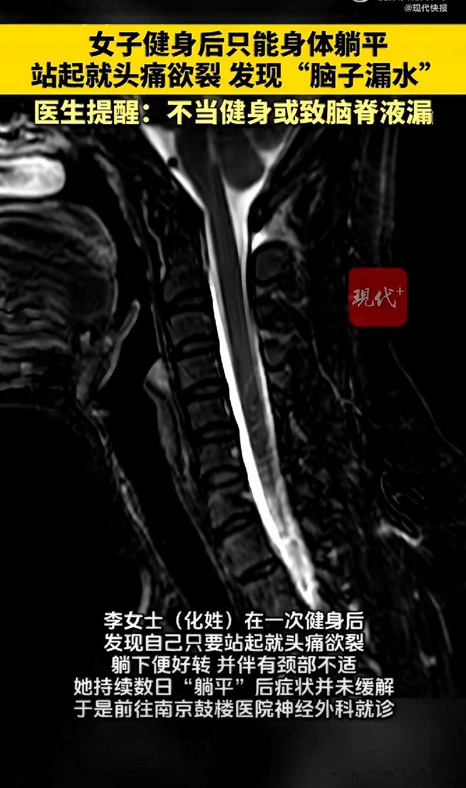南京一位李女士健身过后，落下怪毛病：躺着啥事没有，一站起身就头疼到扛不住，脖子