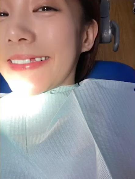 李一桐被磕掉了一颗牙娱乐圈双璧之一，笑眼女神李一桐在节目里自曝拍打戏被撞掉一颗