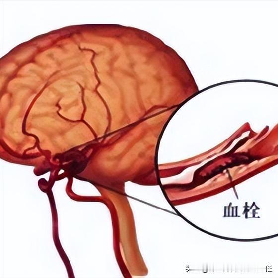 脑梗后怎么吃？这份饮食清单请收好！1.深海鱼（三文鱼、鲭鱼）富含Omega