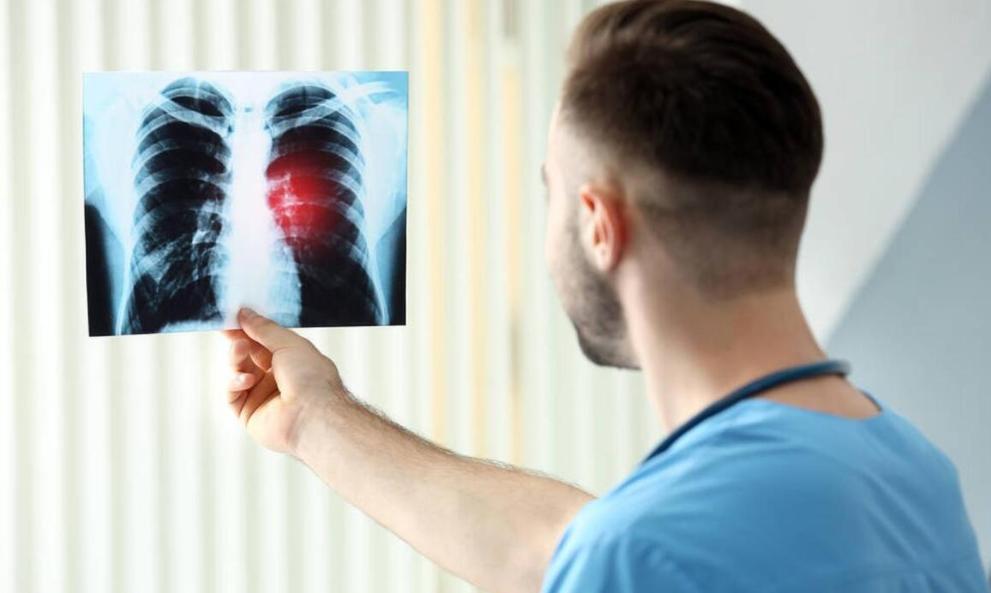 癌王肺癌很会伪装！医生提醒：身体若出现5个异样，尽早就医检查总觉得咳嗽是小感冒