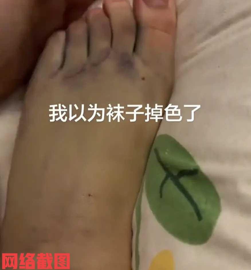 有女子下班回家脱袜后发现脚有不对。原来在女子准备洗澡脱袜后有发生脚上有紫色的