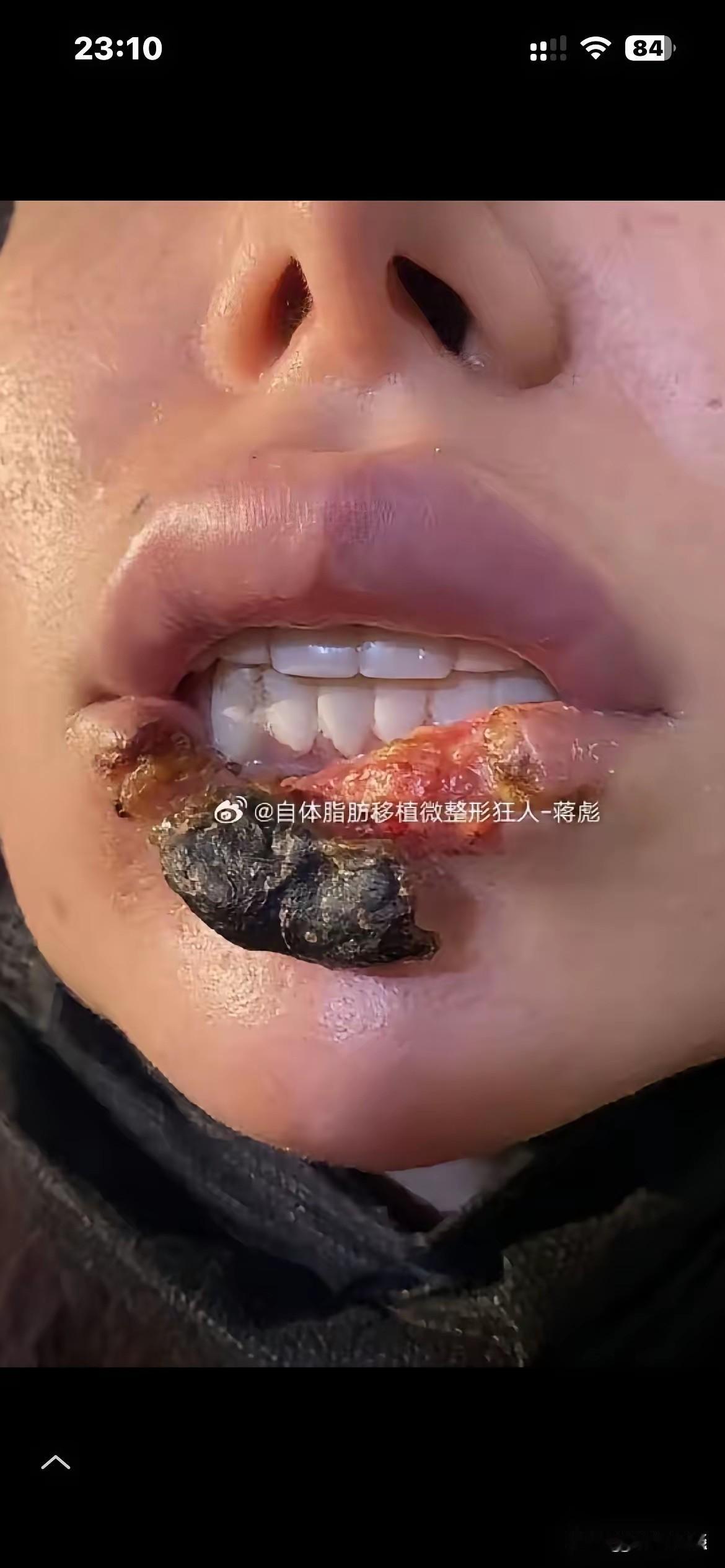刚刷到一张触目惊心的图片，一名女孩因注射玻尿酸，出现血管堵塞，造成皮肤坏死溃烂，