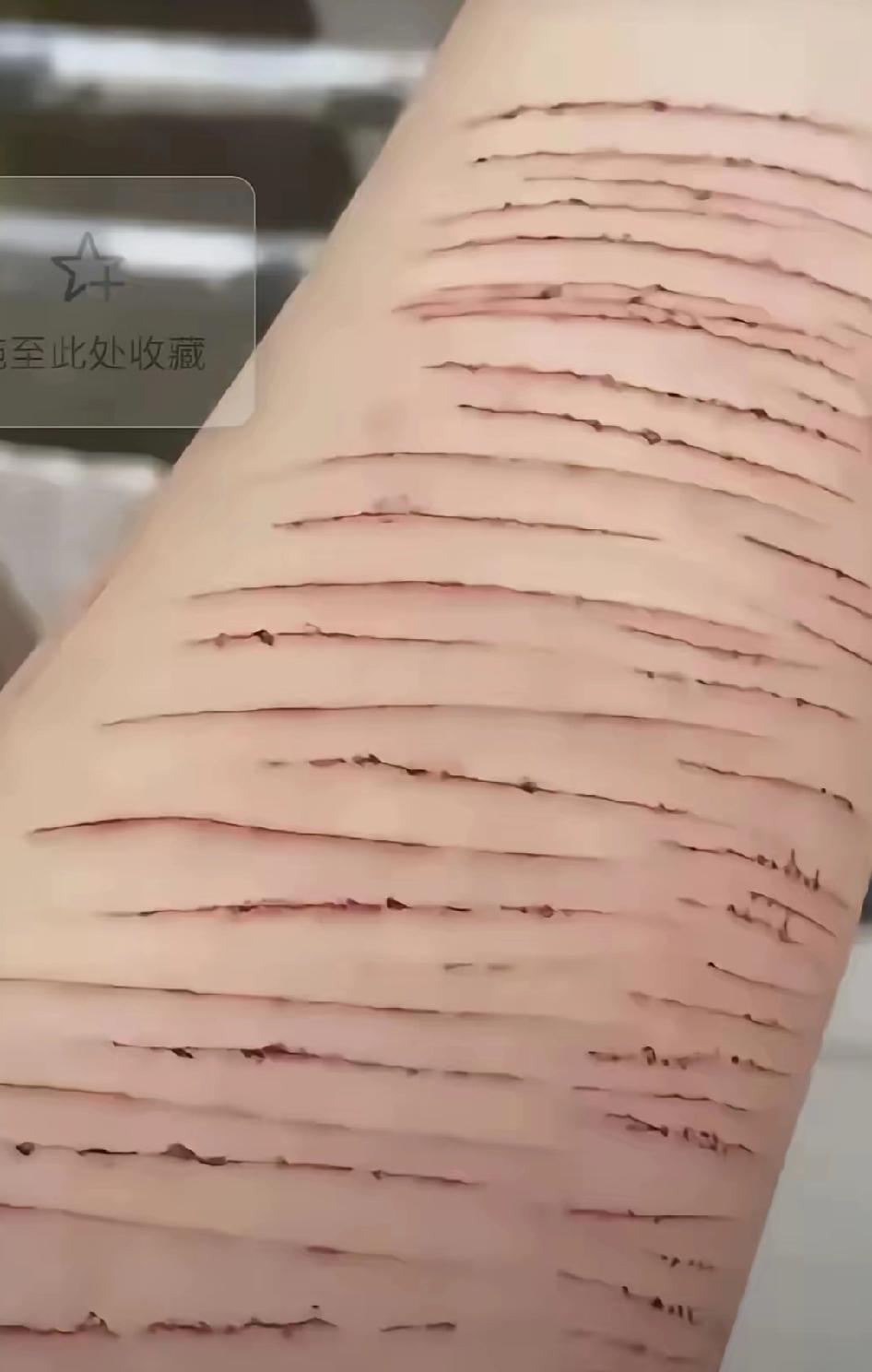 手臂触目惊心，丧失了快乐激素的人据说不疼，通过这样的方式反而可以刺激多巴胺产生?