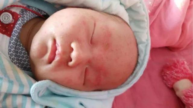 宝宝湿疹反反复复? 儿科医生教你7招, 轻松搞定!