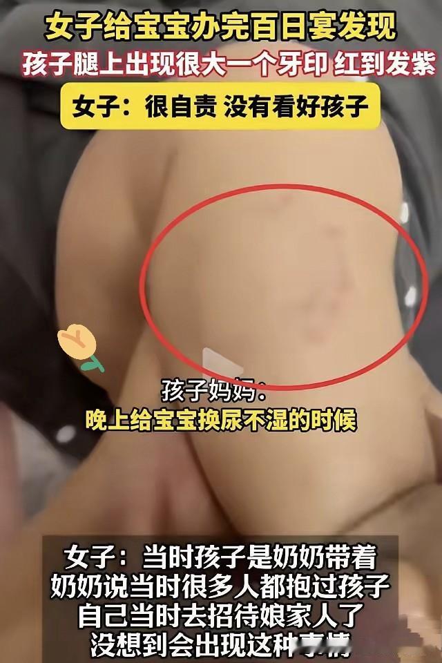 《惊心！百日宴上宝宝腿上惊现大人牙印，人心到底有多难测？》今天要说的这事儿，真