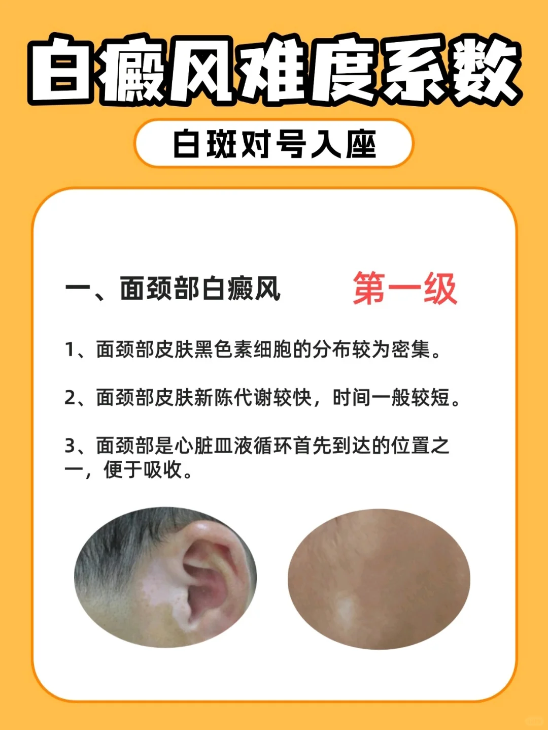 不同位置的白癜风难度系数排行榜，拖不得！
