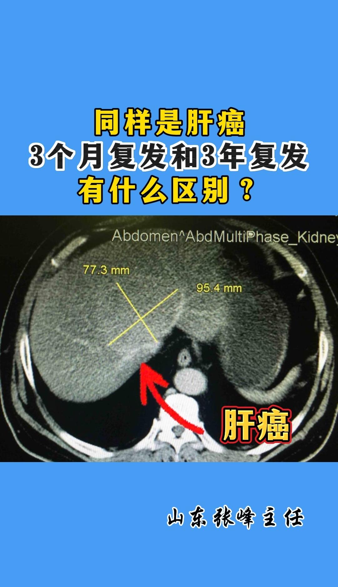 同样是肝癌，3个月复发和3年复发，有什么区别？ 都知道肝癌挺可怕，3个...