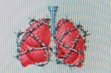 中医说肺结节多是吃出来的，这三种食物真得少碰。首先是烧烤类食物，烧烤时会产生苯