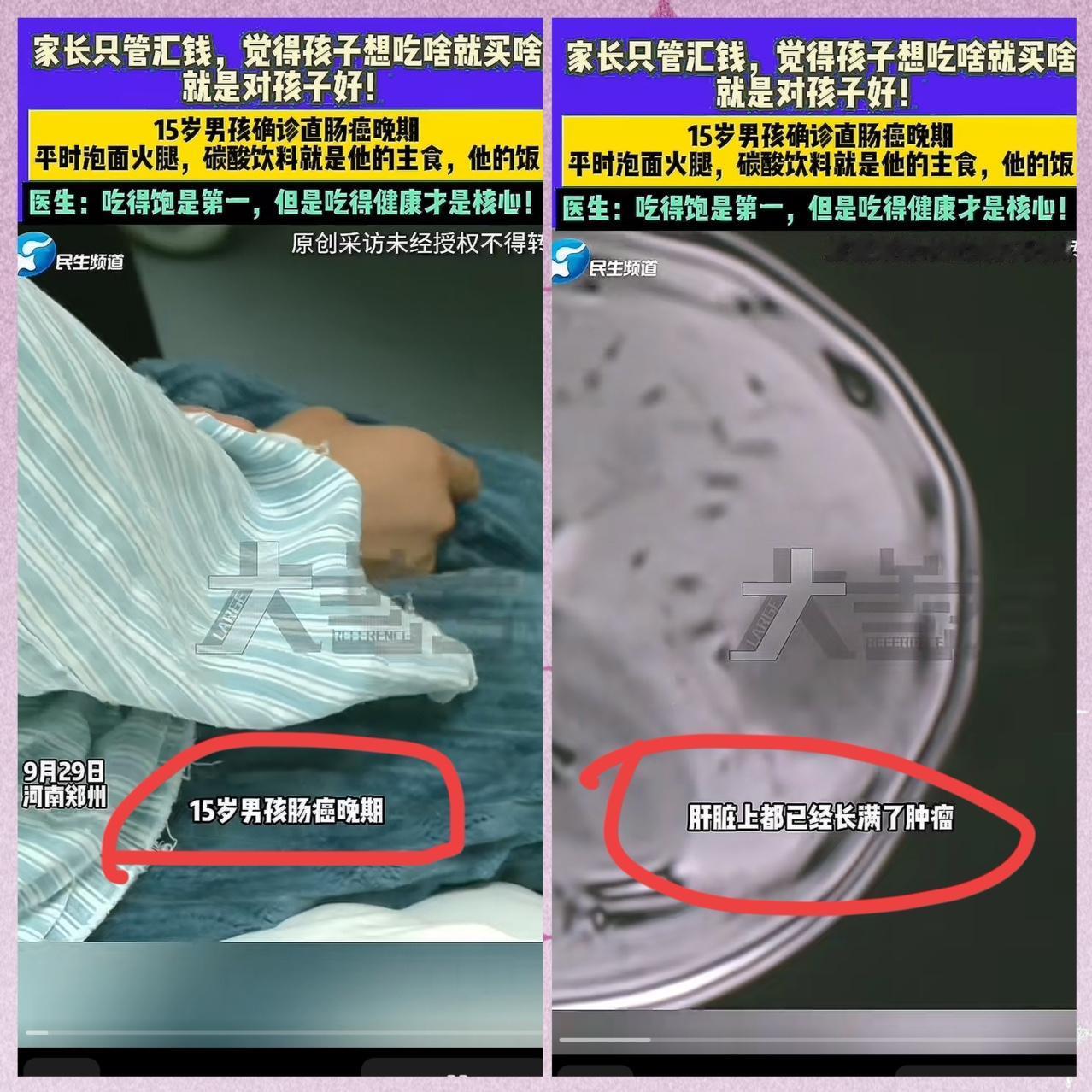 河南那个15岁男孩，直肠癌晚期，肝上密密麻麻全是肿瘤。医生追问病因，在外打工的父