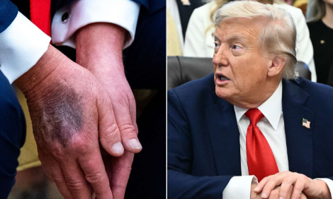 震惊！79岁的特朗普不仅手上的淤青越来越严重，而且脚踝被曝光也出现了严重肿胀。特