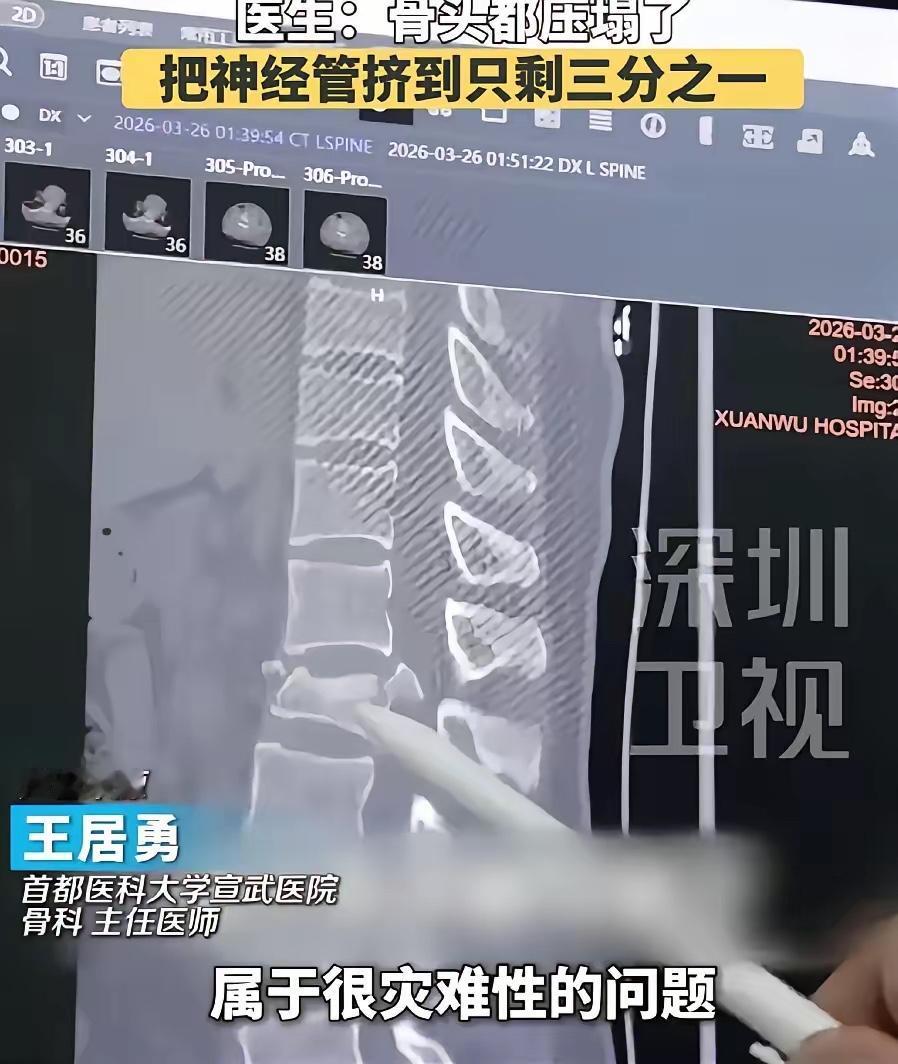 后悔！近日，一25岁女子，边下楼梯边低头玩手机，谁料，一下子踩空了，好巧不巧，直