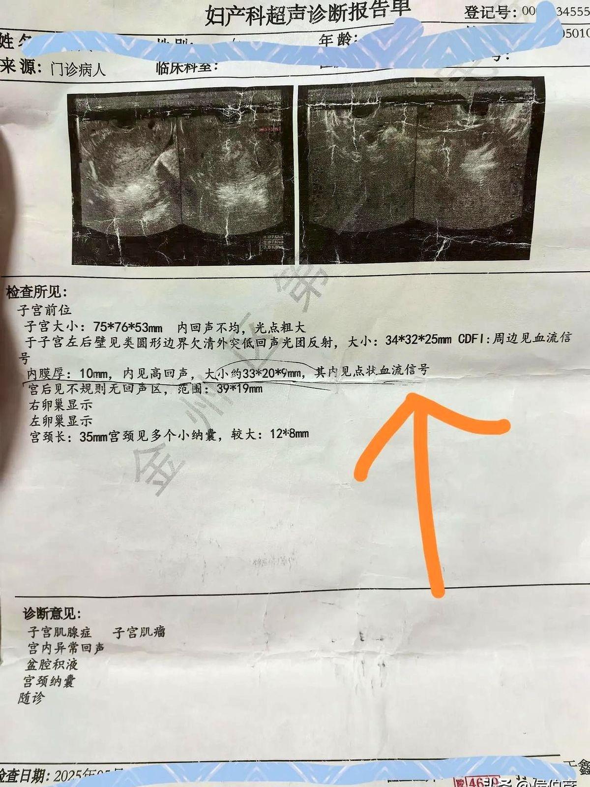 患者查彩超发现子宫内膜出现异常回声，几家医院均建议她进行宫腔镜诊断性刮宫，费用需