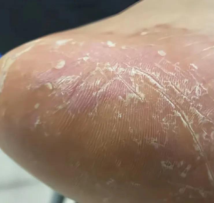 请问大家，你们洗完澡以后，是先穿袜子，还是先穿内裤？杭州一位28岁的王先生，就因