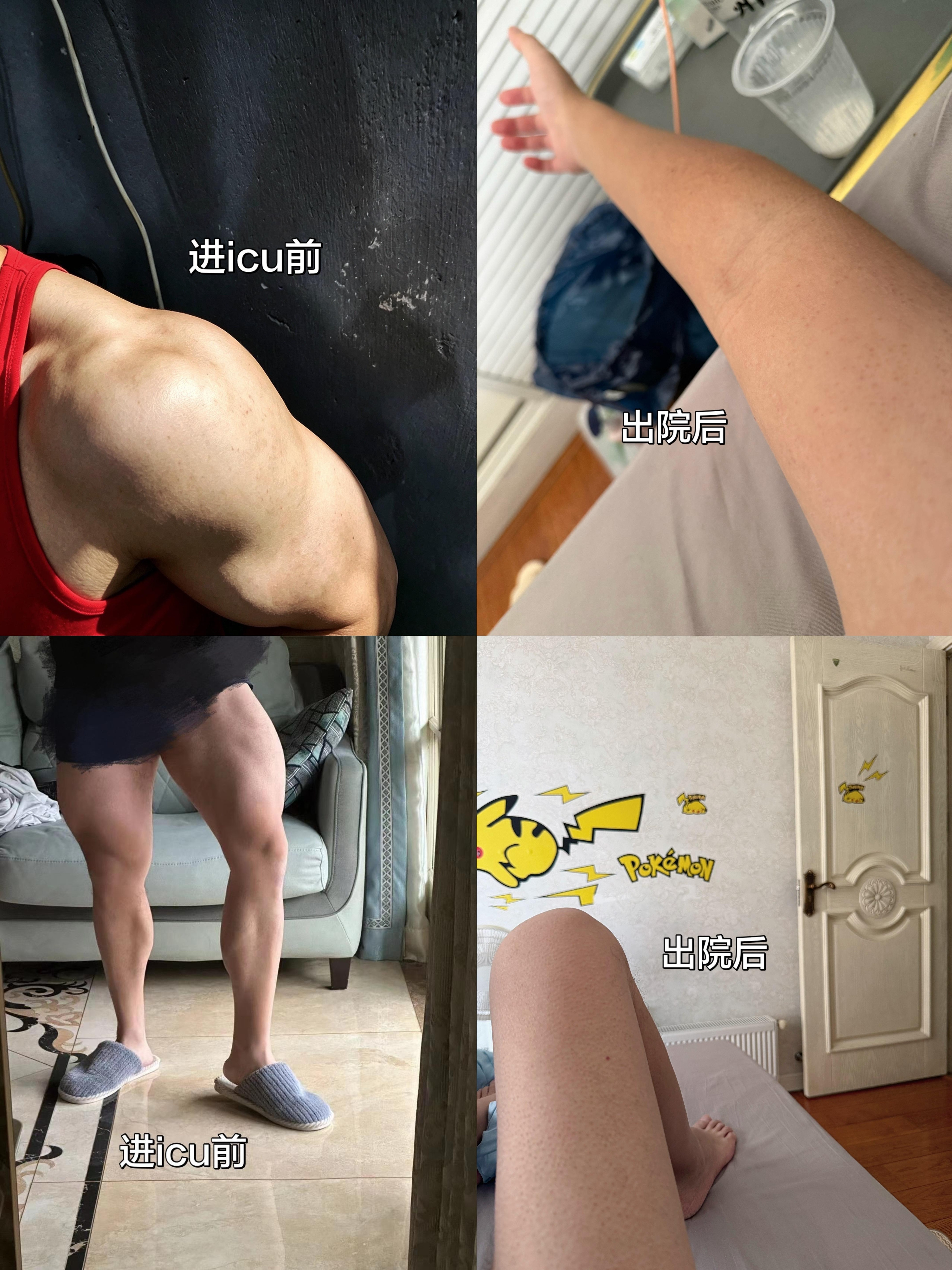 网友分享进icu前后的肌肉变化，直观地意识到“存肌肉就是存未来”这句话的含金量