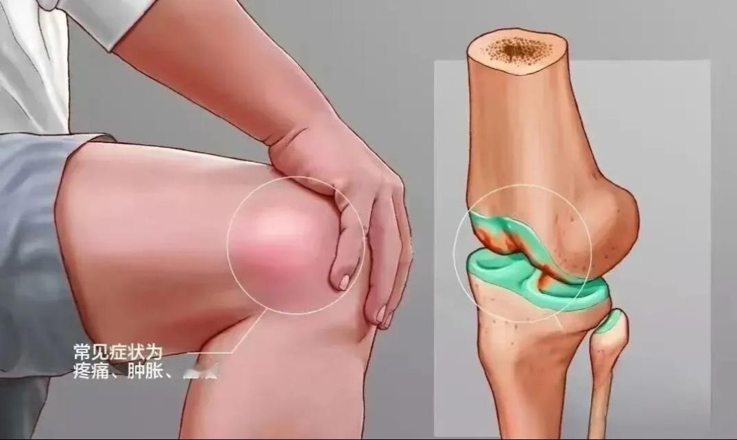 我肿胀疼痛的关节炎终于治愈了，我关节炎有三十年了，每一次关节肿胀疼痛发作，晚上疼