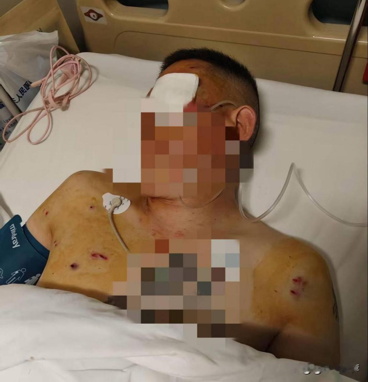 男子取款170万遭抢劫致重伤，银行安保责任引发争议去年7月2日，倪先生在河南