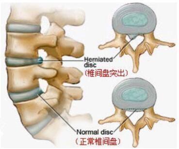腰椎间盘突出不等于腰椎间盘突出症, 别着急去治