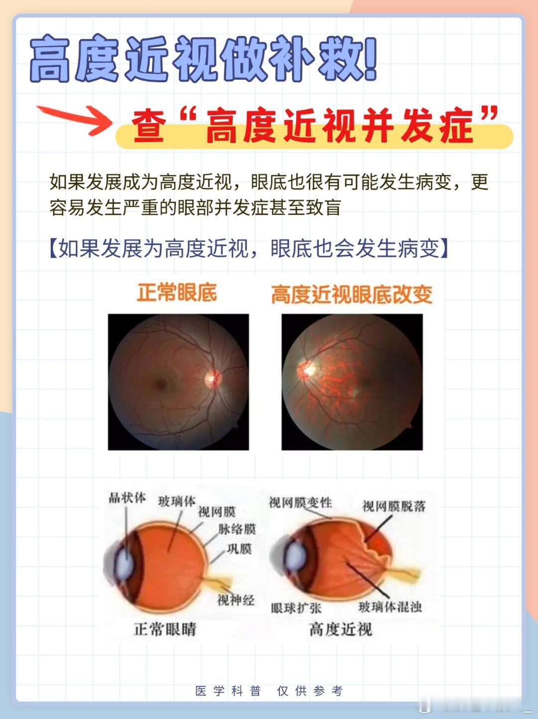 近视焦虑眼科医生划重点：四查轻松做好孩子近视防控🔍第一查：视力筛查表👉