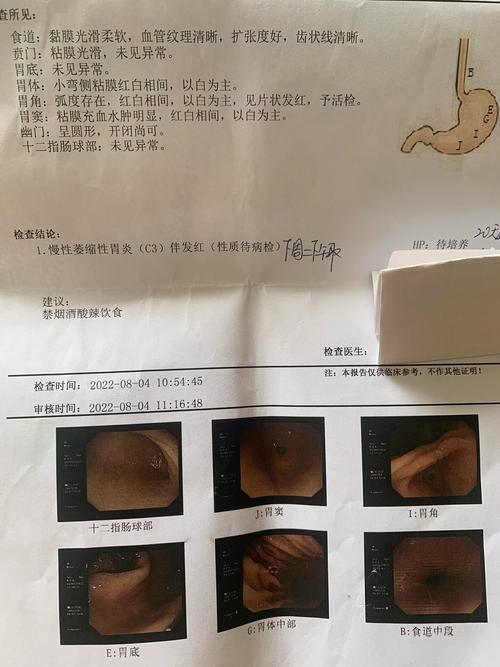 萎缩性胃炎，不同的病情程度，癌变几率各是多少?教你判断萎缩性胃炎癌变几率看这