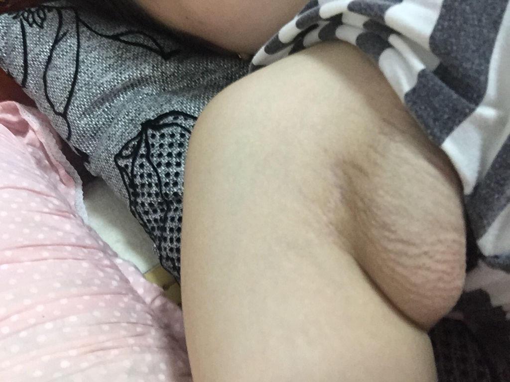 怀孕之后左右腋窝下长了这个东西, 网友们知道是什么吗?