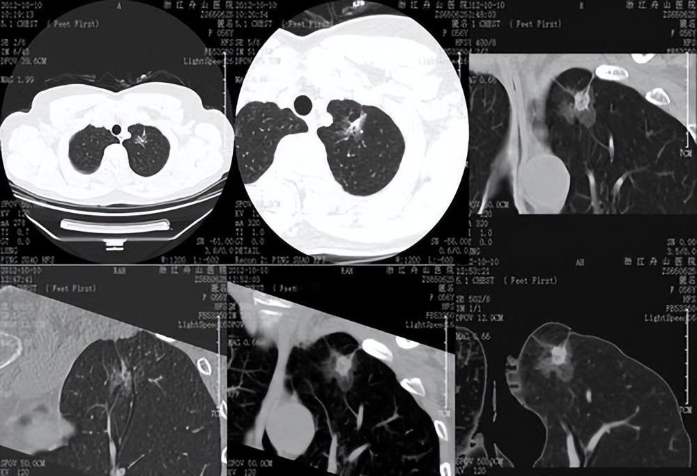 90%的肺结节是良性，但那10%的“危险分子”恶变时会露出马脚！记住这