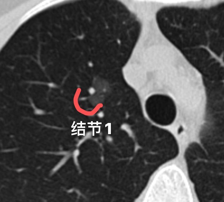 29岁姑娘查出两处肺磨玻璃结节，连4mm小结节我也帮她切掉了......今天跟大