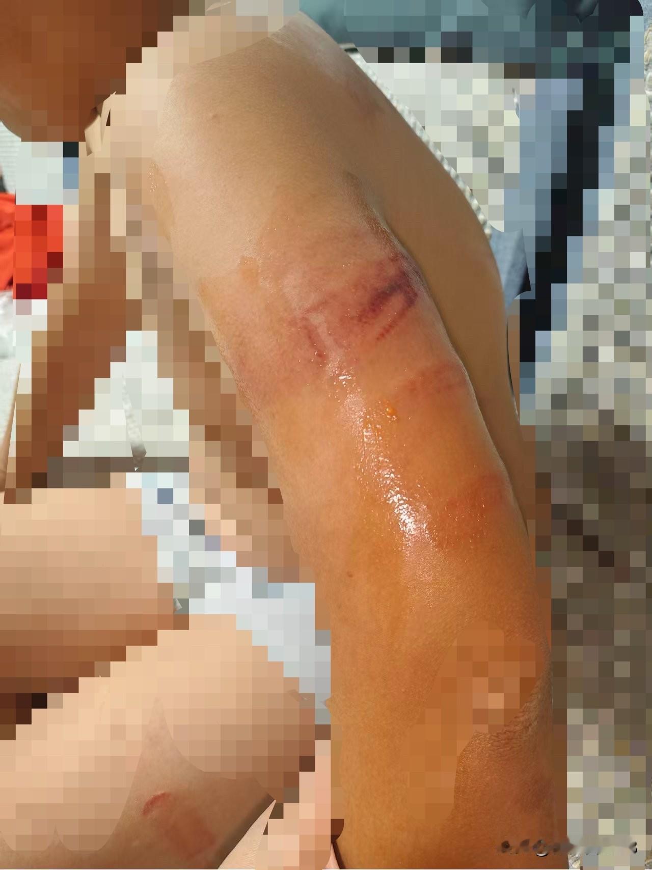 如果你家孩子不爱学习，一定要找原因。昨晚孩子被他爸打了，打的皮开肉炸，原因就