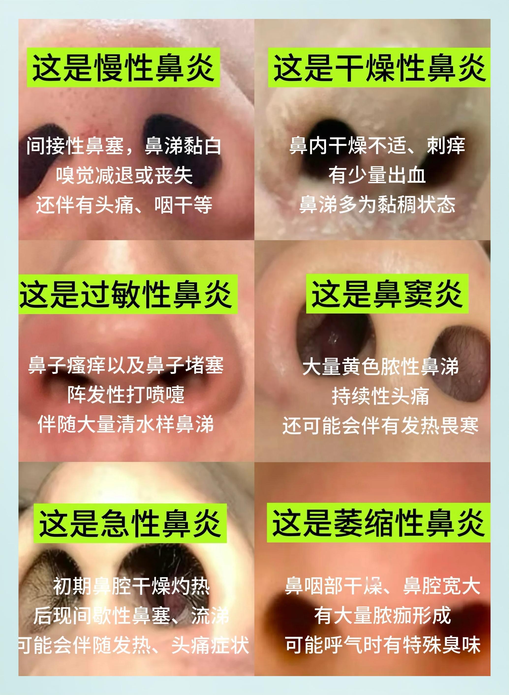 鼻炎分三类，方子别乱选｜中医不是光通鼻子很多人被鼻炎常年困扰，一味找通鼻的药，却总反复。在中医眼里，