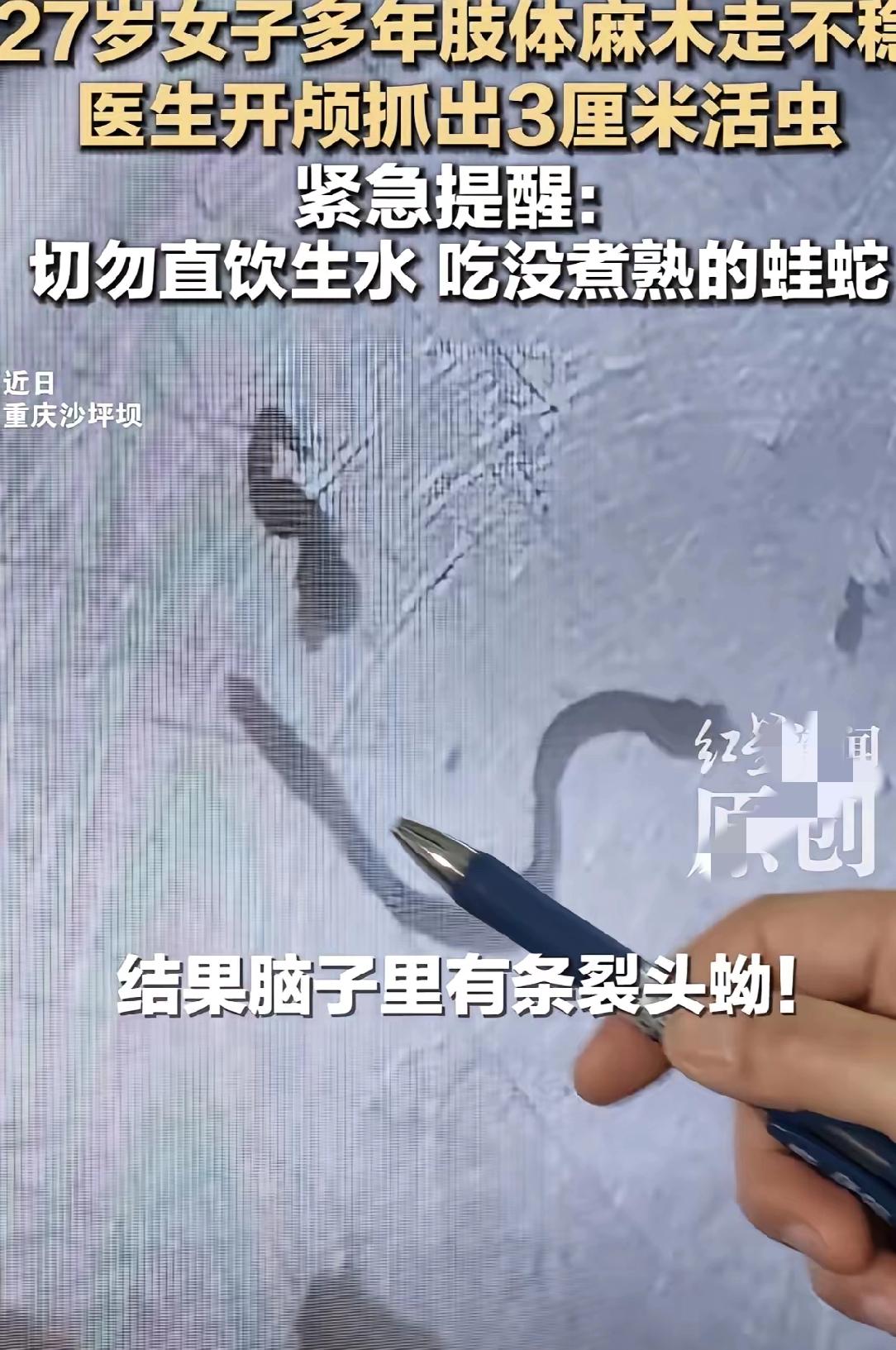 重庆一女子，头疼了5年。​跑遍大医院，医生都说可能是脑瘤。​结果开颅后，取出