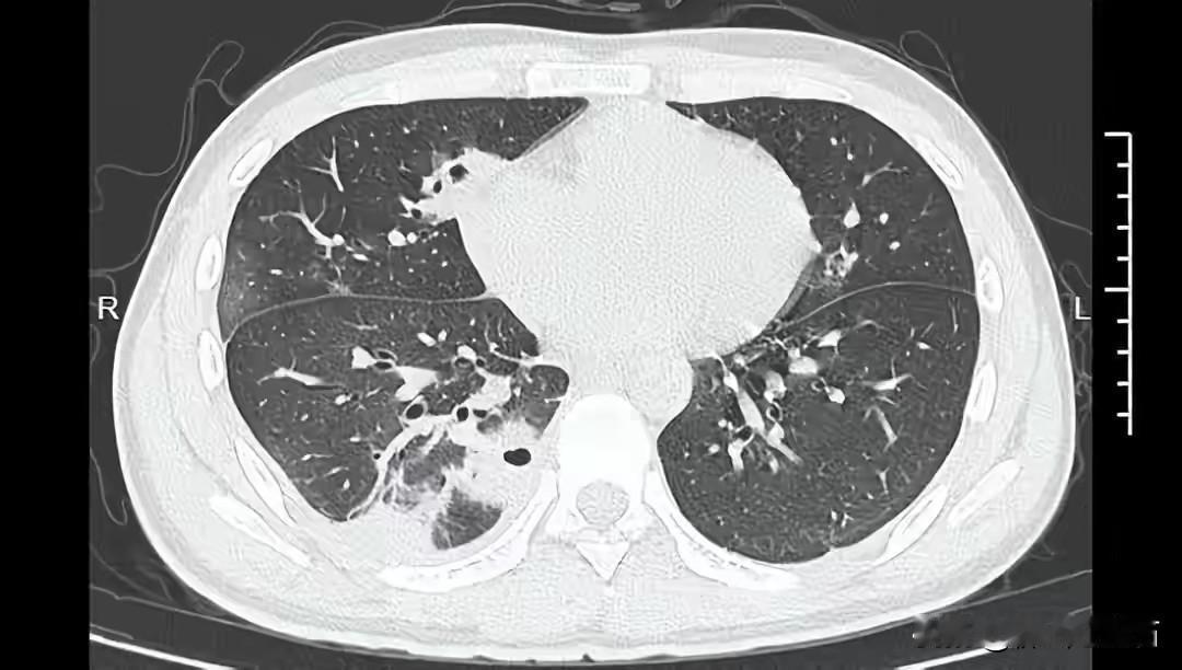 年轻人挤痘痘真得悠着点！宁波20岁的大二学生小林，就因为挤痘进了大麻烦。为备考熬