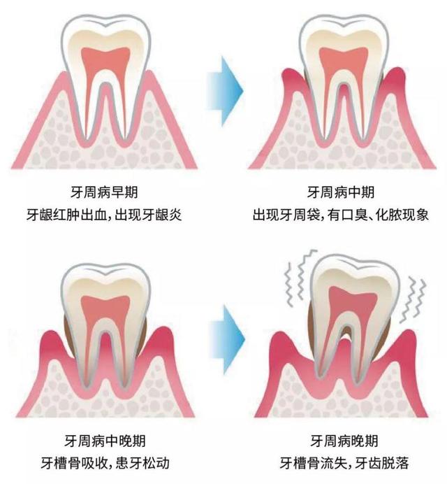 这3种情况的牙龈肿痛不是上火! 这样治疗才能有效解决!