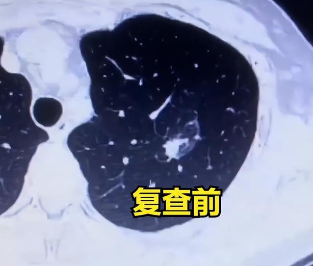 肺结节切了还会长？很多查出肺结节做手术的朋友，都会遇到一个困惑：明明已经把结节手