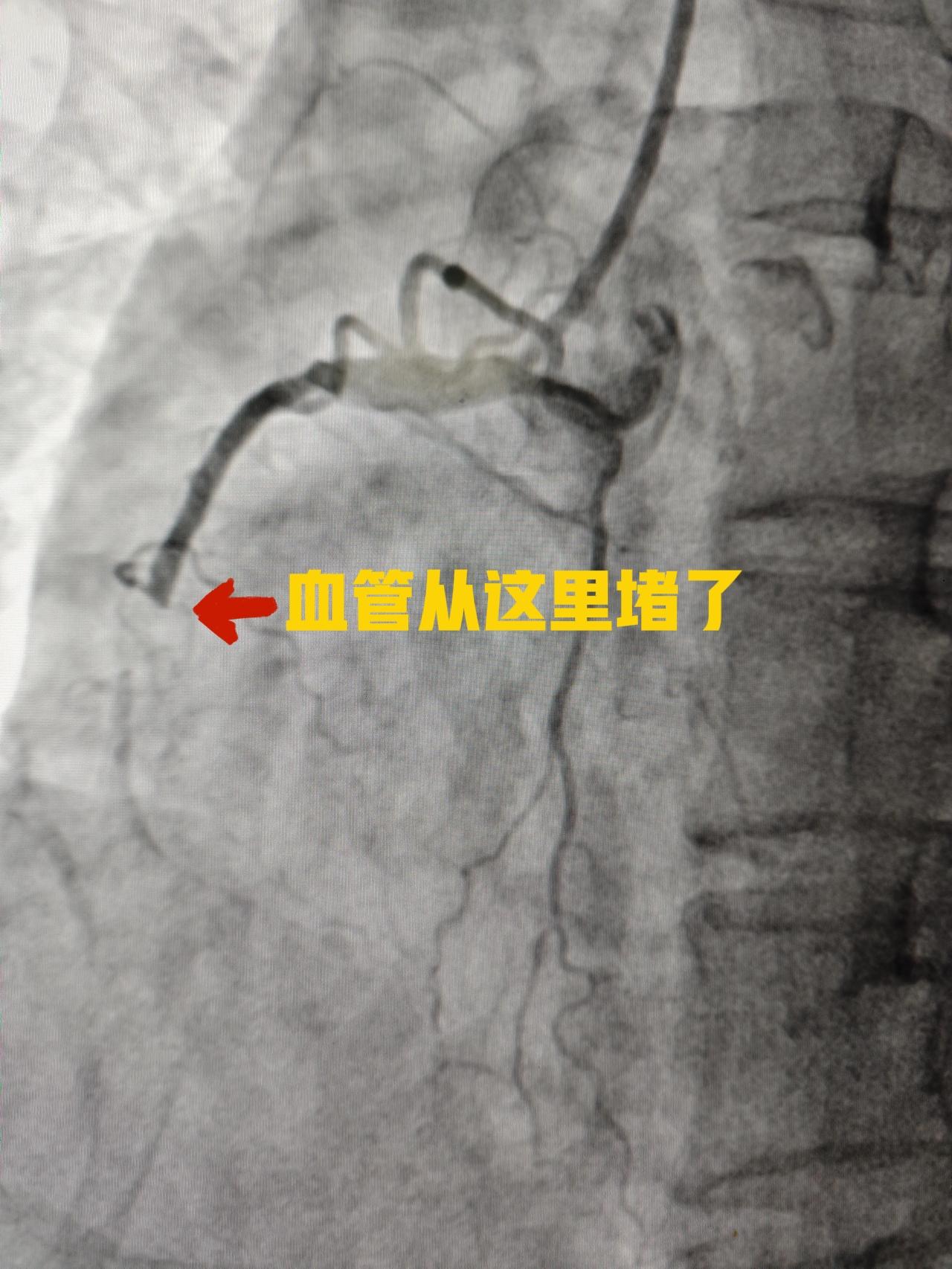 闭塞血管成功开通又一例。65岁女性患者，日常活动只有轻微胸闷不舒服，家里也没有