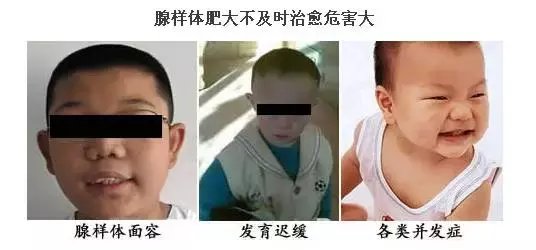 孩子打呼不是睡得香, 当心腺样体肥大!
