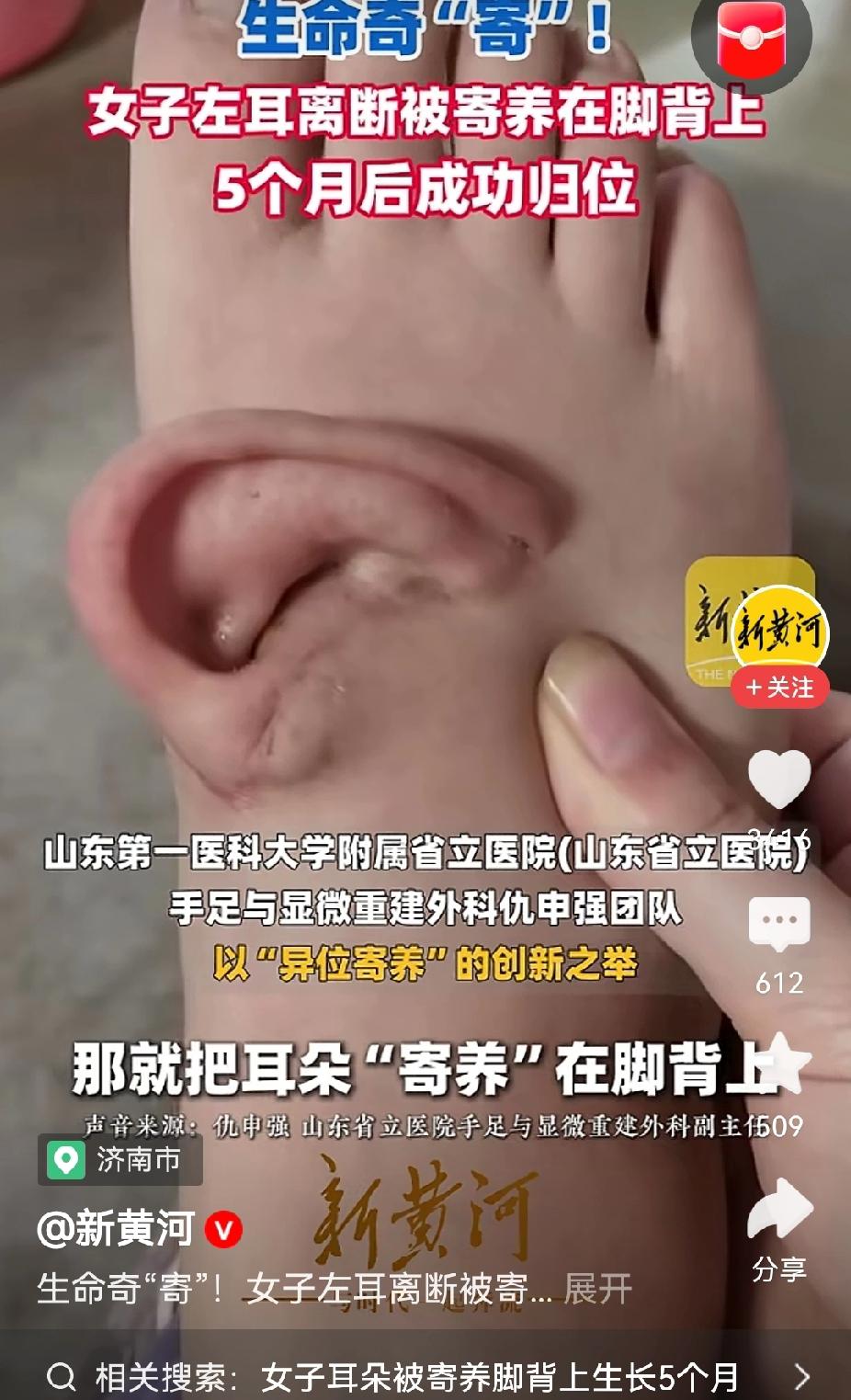 济南医疗也太牛了吧，居然玩起了邪修，把耳朵移植到脚丫上。事情是这样的：五个