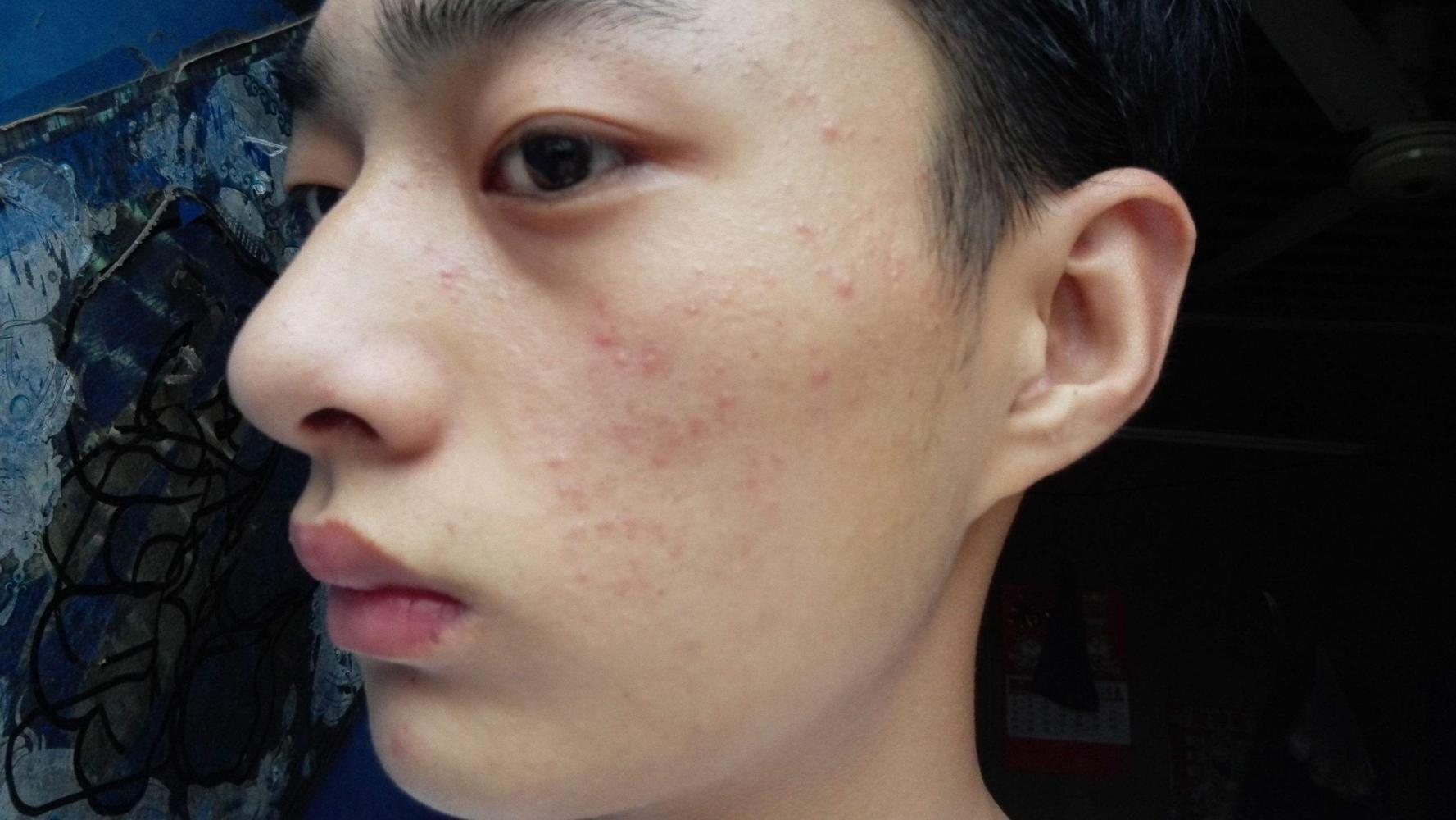 脸上长痘痘怎么调理?