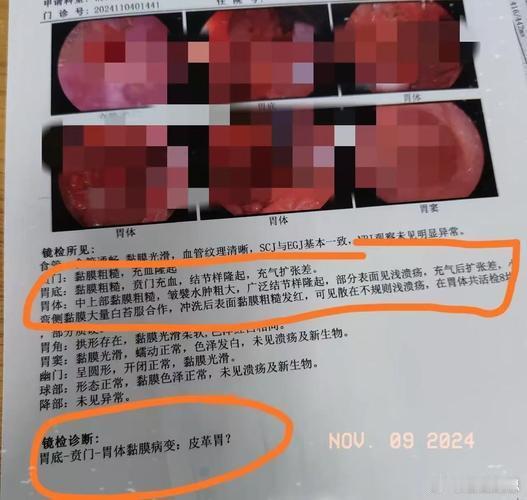 男子肚子疼被误诊胃癌全胃切除武汉吴先生喝口冷水肚子疼，送医查出“胃溃疡”，外院教