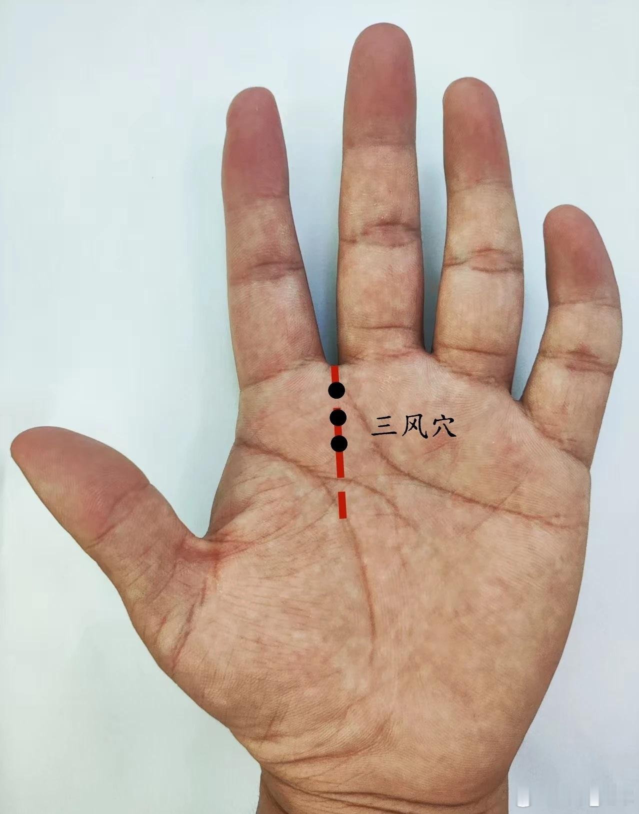 风火牙痛三风穴三风穴源自董氏奇穴位置：在手掌面，食指掌骨与中指掌骨之间，掌指横