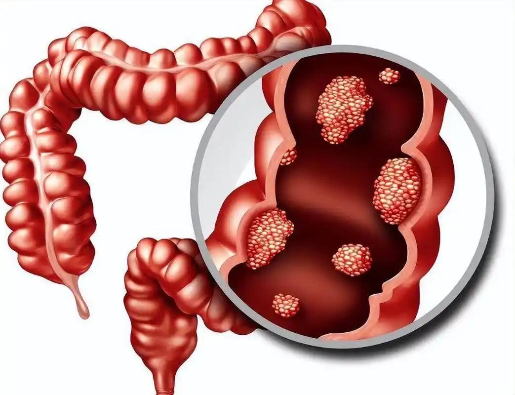 张阿姨今年62岁，平时最爱跳广场舞，上个月突然腹痛便血，检查后竟是晚期肠癌，