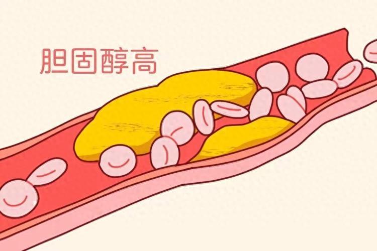 胆固醇最怕的7种食物，建议中老年人多吃，稳定胆固醇少生病65岁的老人去做常规