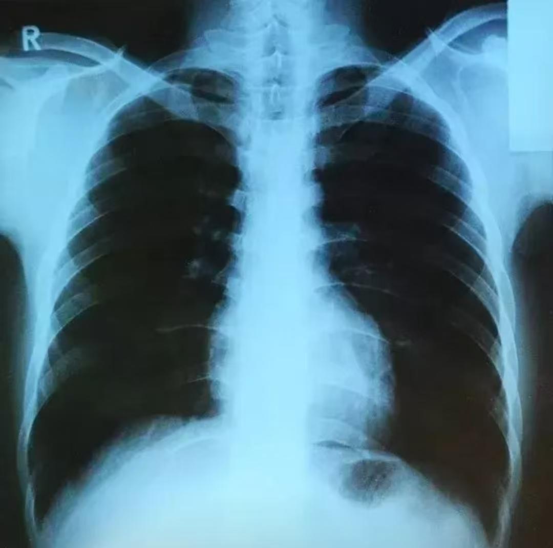 CT越来越先进了，今后的CT检查不仅能清晰看到2mm以下的肺结节以及人体肺部最小