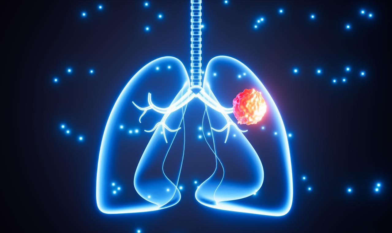 肺里面有很多种癌，哪一种癌的恶性程度最低，不开刀也能活很多年肺内恶性肿瘤分很多