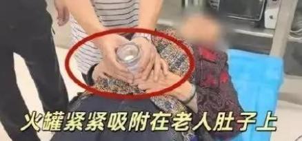 悲剧还是发生了！贵州贵阳，一七旬老人自行在家用塑料罐拔火罐，却因时间太久导致塑料