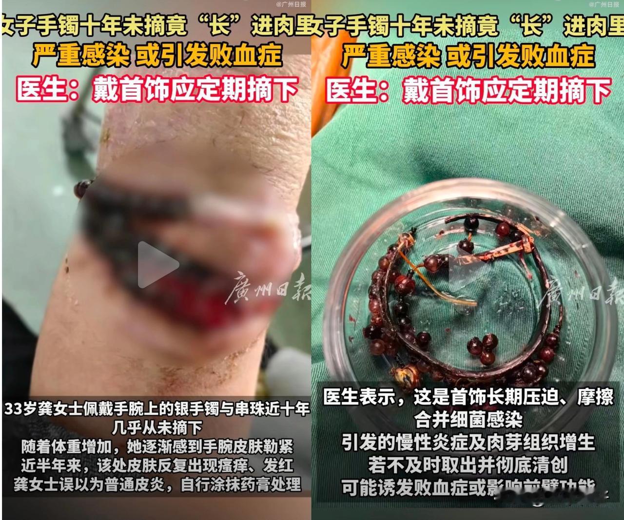近日，福建宁德33岁龚女士的经历引发关注——她因长期未取下手镯，体重增长后手腕被