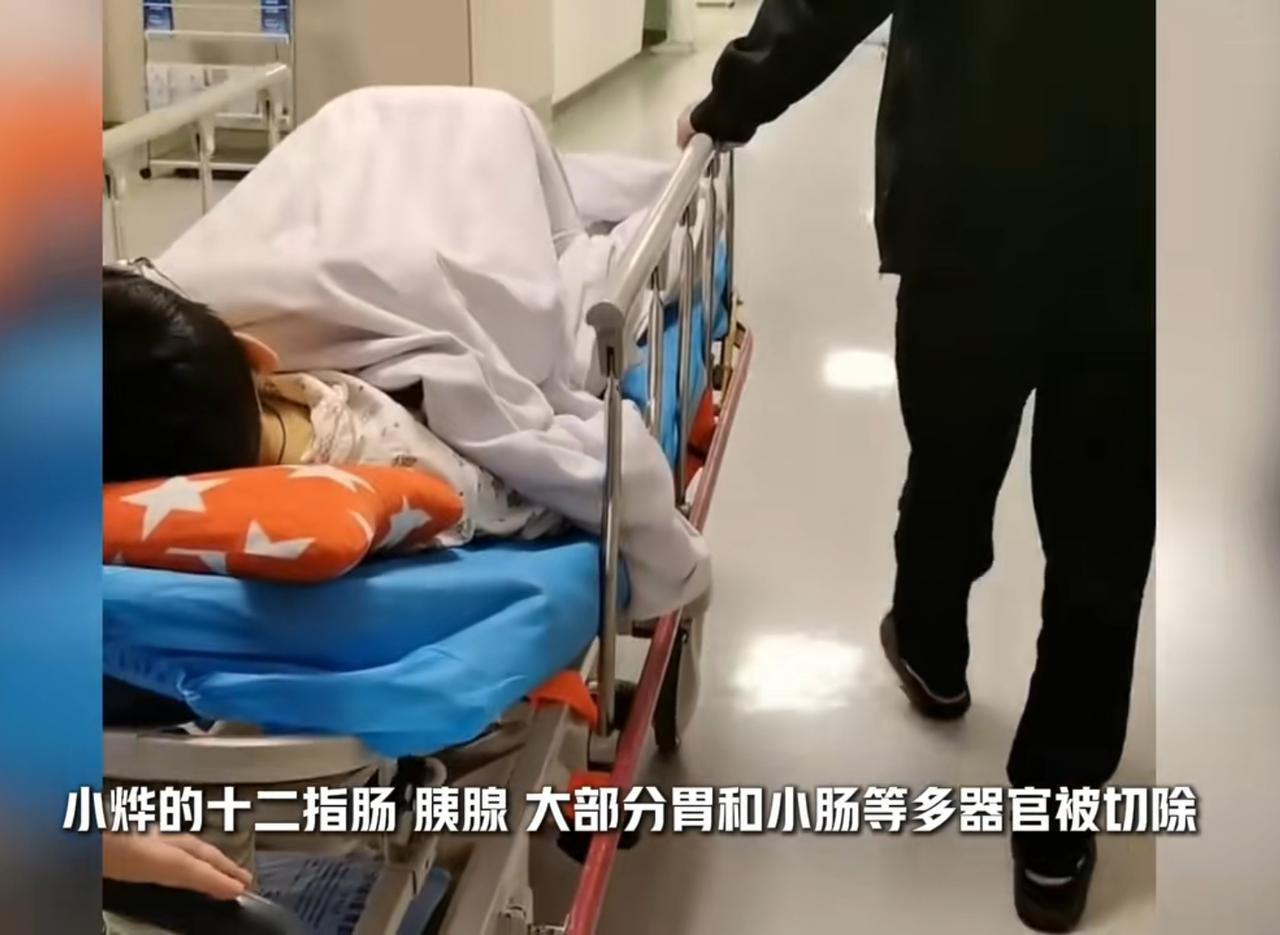 太痛心了!10岁小孩因腹痛入院检查后被医院切除多个消化器官10岁的小烨原