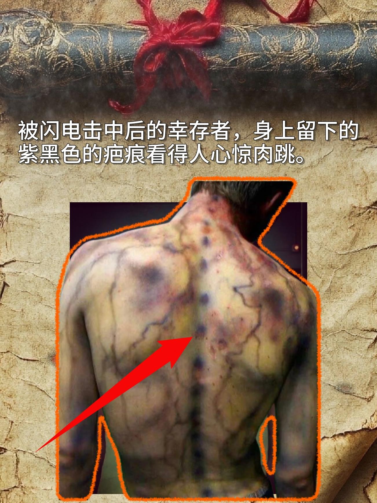 被闪电击中后的幸存者，身上留下的紫黑色的疤痕看得人心惊肉跳。