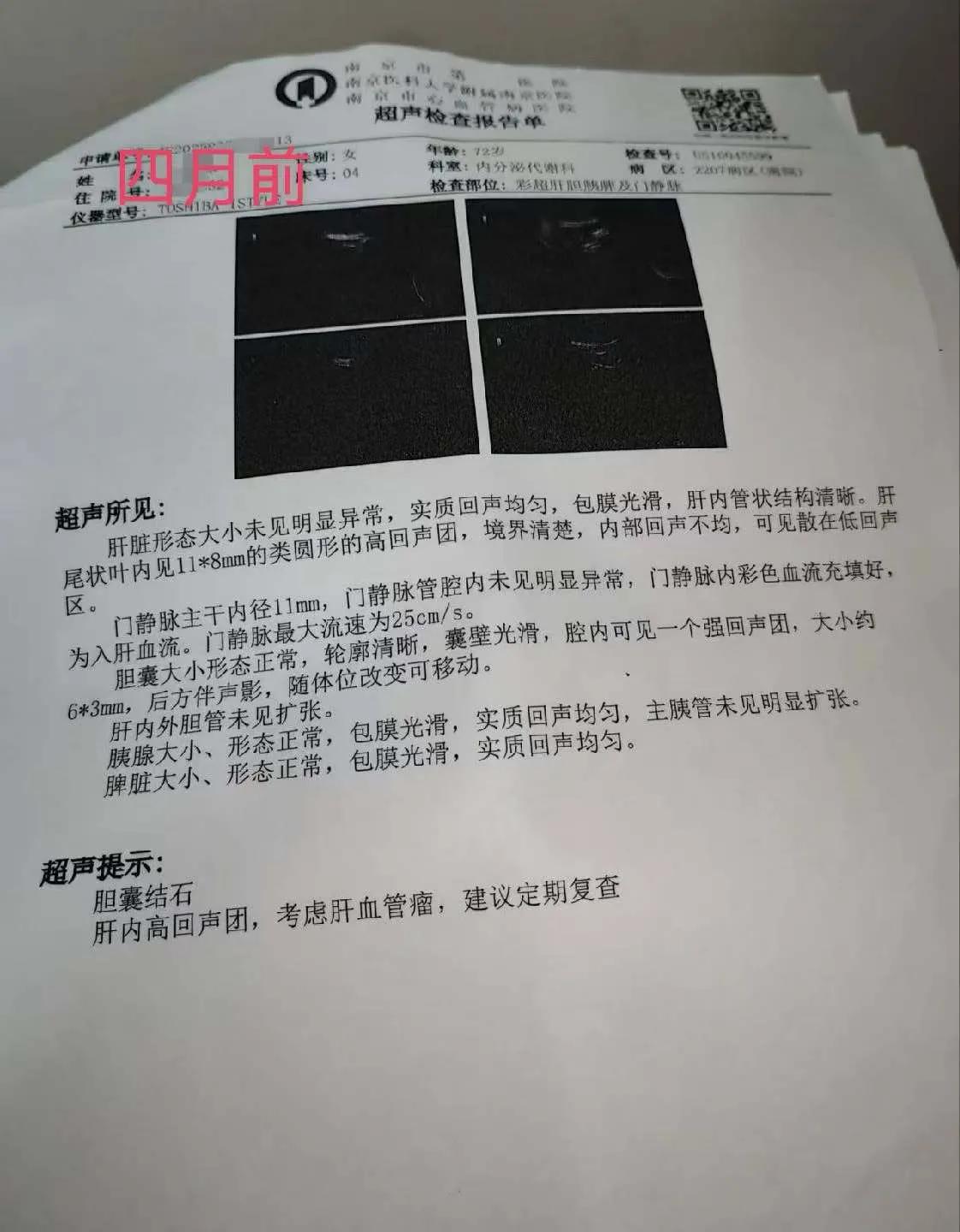 一位73岁的阿姨，胆囊结石困扰许久，外科建议手术，她抱着试试的心态选了中医调理。