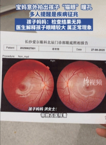 长知识了！”湖南长沙，女子闲着无聊给女儿拍照，不料却看到孩子眼睛发红像“猫眼”，