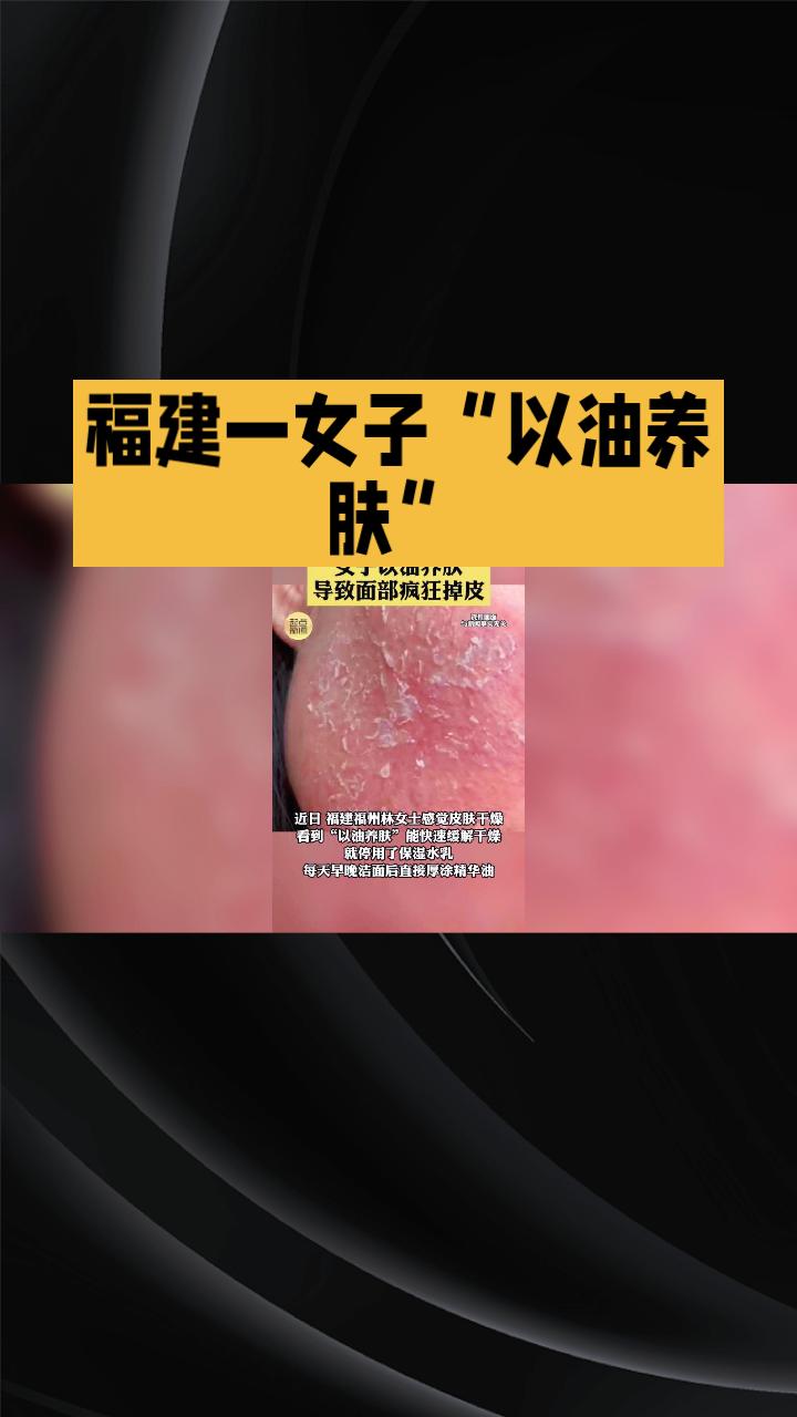 “以油养肤”成了冬季护肤新趋势，但福建一女子却因此面临面部刺痛、疯狂掉皮的困境。